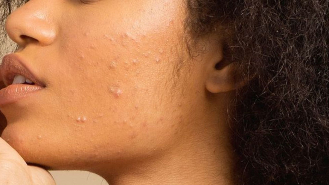 WHAT'S THE BEST SPF SUNSCREEN FOR ACNE?